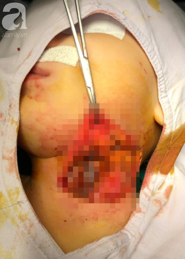 Bé gái 11 tháng tuổi suýt chết và nhập viện trong tình trạng vô cùng nguy kịch sau khi ăn chính món mà mẹ nào cũng từng nấu cho con-4