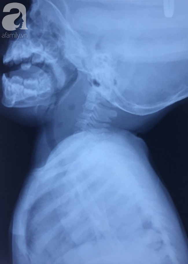 Bé gái 11 tháng tuổi suýt chết và nhập viện trong tình trạng vô cùng nguy kịch sau khi ăn chính món mà mẹ nào cũng từng nấu cho con-3