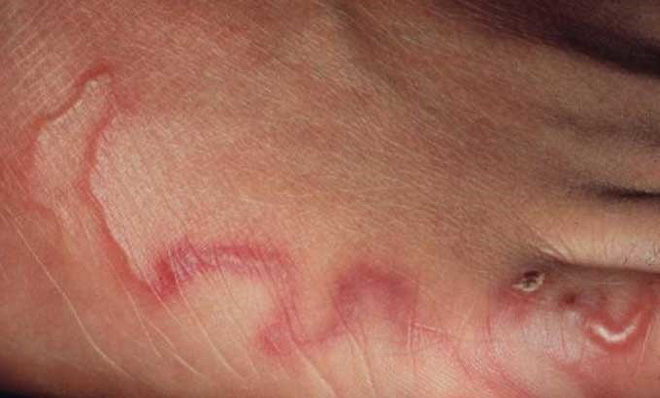 Những sai lầm về việc tẩy giun sán hầu như ai cũng mắc phải-2