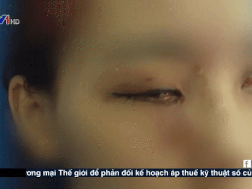 Mù mắt do tiêm filler nâng mũi - hậu quả từ can thiệp làm đẹp