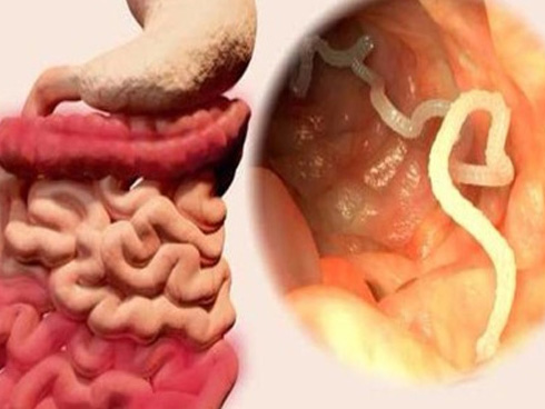 Người đàn ông đau đầu 30 năm, bác sĩ lôi ra sinh vật 10cm trong não-3