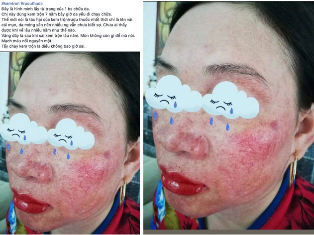 Nhìn khuôn mặt nát vì kem trộn thế này, các chị em muốn đẹp thì đừng tiếc rẻ thời gian-1