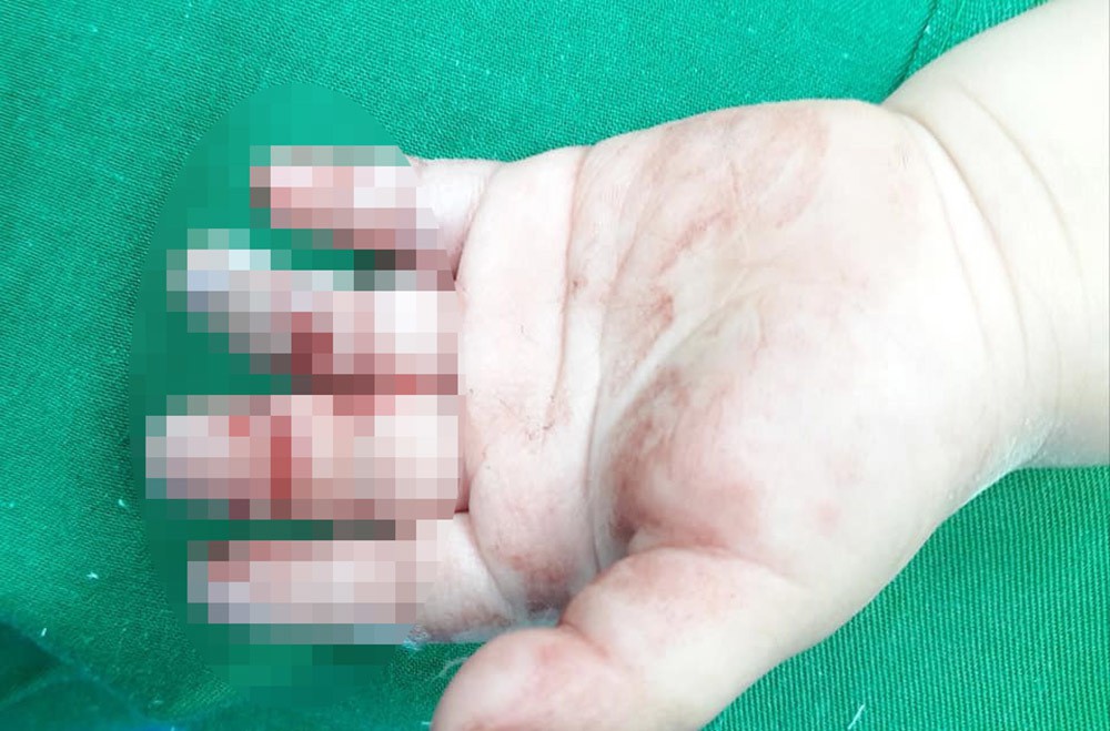 Bé trai 16 tháng tuổi bị máy xay thịt cuốn dập nát, hoại tử ngón tay-1