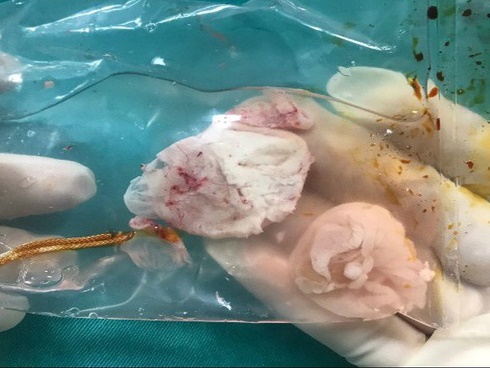 Hãi hùng cảnh bác sĩ bắt sán lợn trưởng thành dài 5,2 mét trong cơ thể cô gái trẻ-2