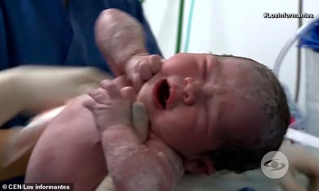 Đỡ đẻ cho một sản phụ xong, bác sĩ chết điếng người khi nhìn thấy một thai nhi khác đã hình thành tay chân trong bụng bé gái mới sinh-3