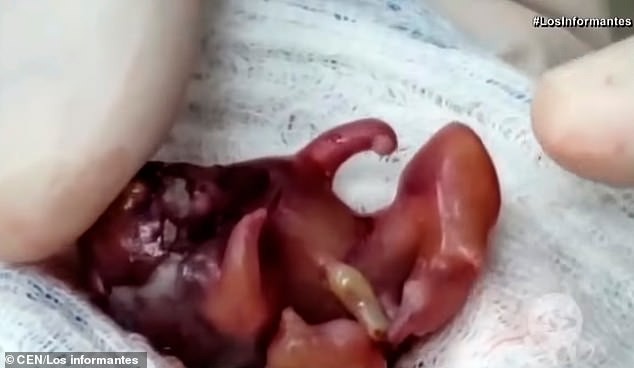 Đỡ đẻ cho một sản phụ xong, bác sĩ chết điếng người khi nhìn thấy một thai nhi khác đã hình thành tay chân trong bụng bé gái mới sinh-4