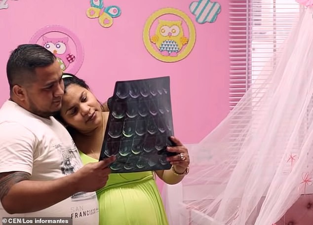 Đỡ đẻ cho một sản phụ xong, bác sĩ chết điếng người khi nhìn thấy một thai nhi khác đã hình thành tay chân trong bụng bé gái mới sinh-6