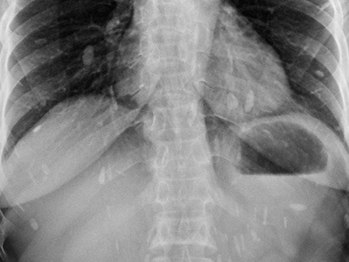 Mệt mỏi vào viện khám, tá hỏa phát hiện sán lá gan sinh sôi khắp cơ thể