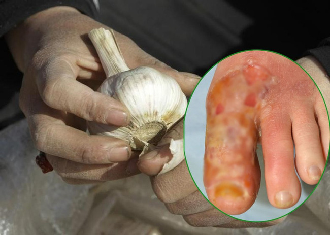 Những cách chữa bệnh bằng tỏi sai lầm nhưng nhiều người vẫn liều mình áp dụng-3