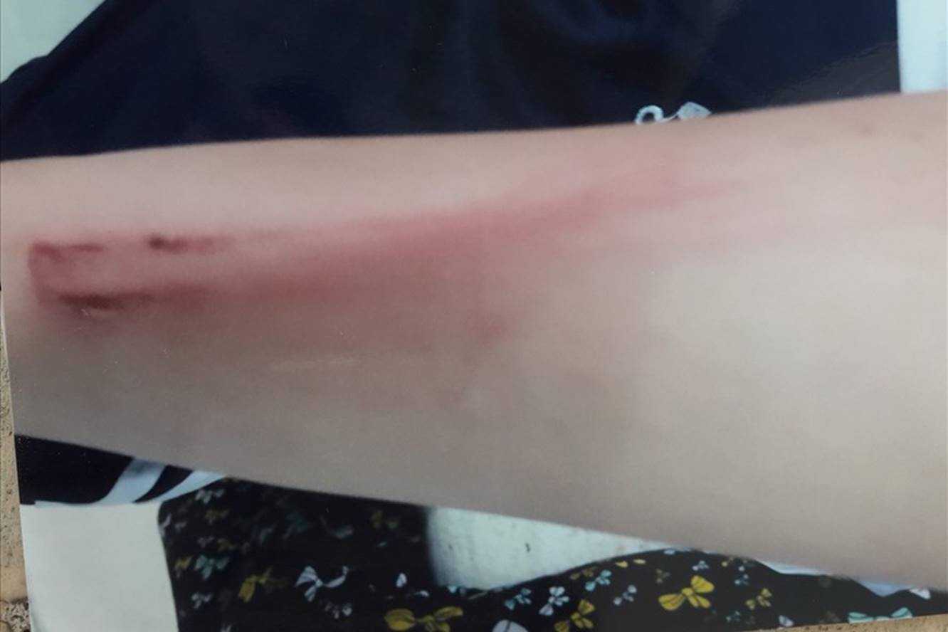 Cha đánh con gái 12 tuổi nhập viện-1