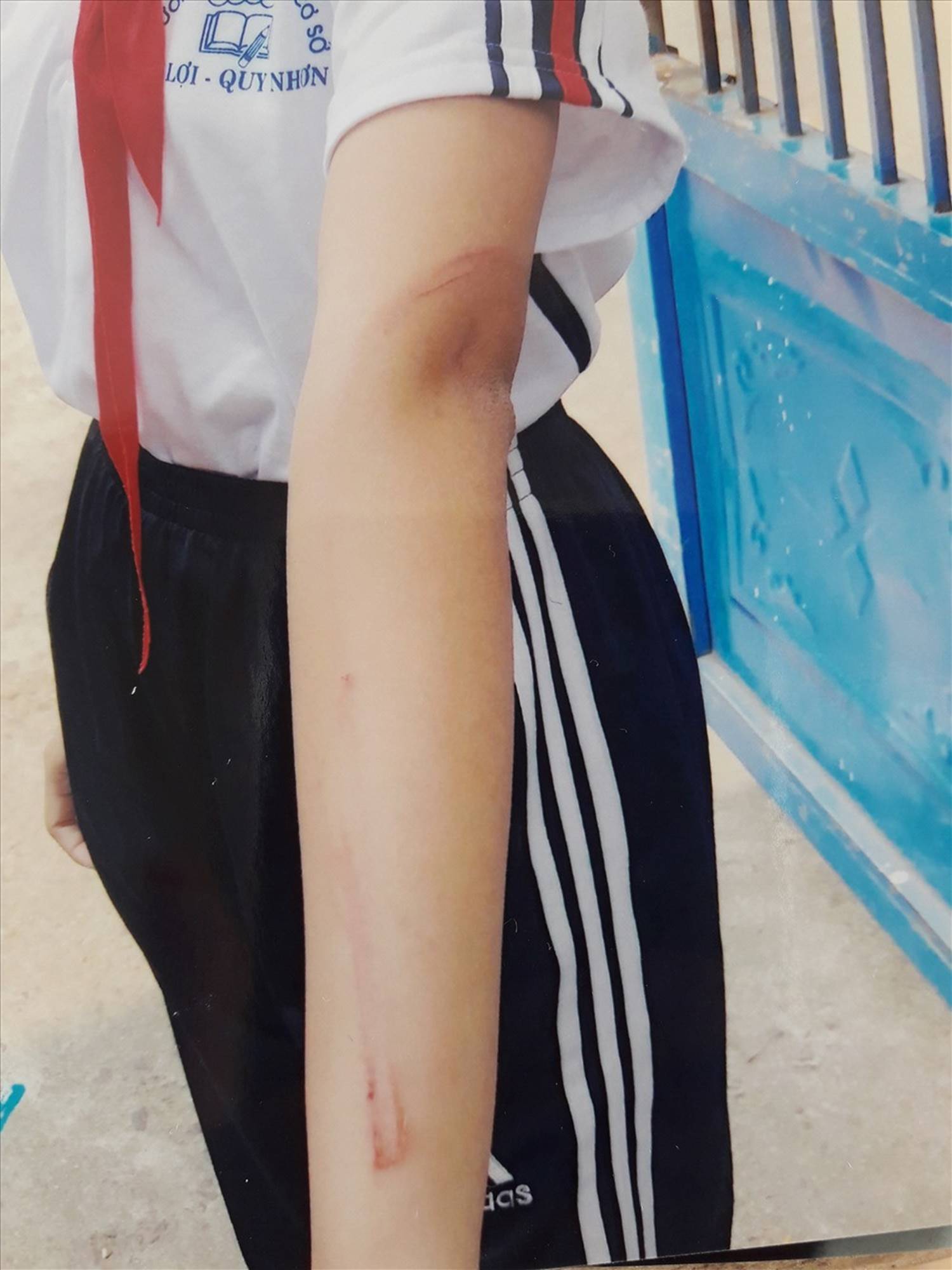 Cha đánh con gái 12 tuổi nhập viện-2