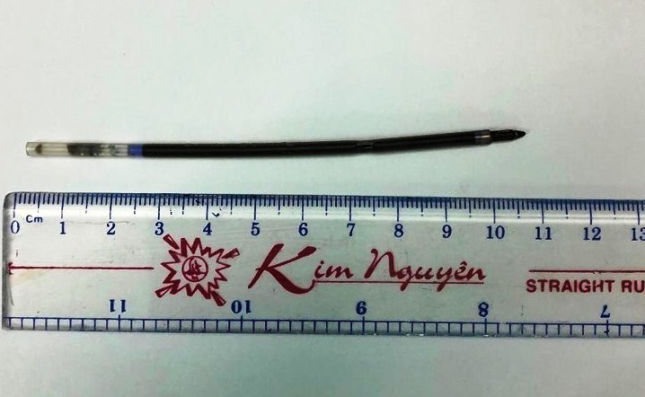 Thanh niên nuốt ruột bút bi dài hơn 10cm vào bụng-1