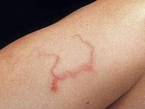 8 dấu hiệu cảnh báo cơ thể nhiễm ký sinh trùng-9