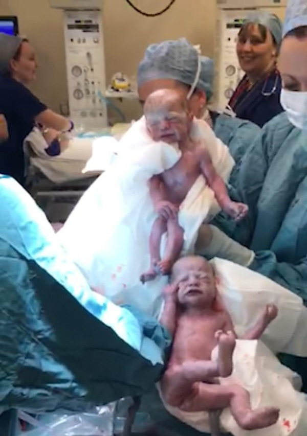 Dù đã được báo trước nhưng bà mẹ vẫn không thể tin vào mắt mình khi bác sĩ đón một đàn con trong bụng cô chào đời-3