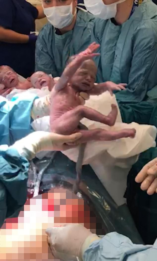 Dù đã được báo trước nhưng bà mẹ vẫn không thể tin vào mắt mình khi bác sĩ đón một đàn con trong bụng cô chào đời-5