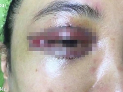 Háo hức bỏ tiền đi cắt mí mắt, mẹ trẻ nhận về đôi mí cách xa cả vạn dặm, đi ngủ không thể nhắm lại được-6