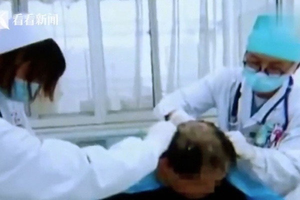 Tai nạn hy hữu: Người đàn ông suýt mất mạng, bị bác sĩ cạo sạch đầu chỉ vì nhầm lẫn nhiều người dễ mắc phải trong lúc tắm gội-1