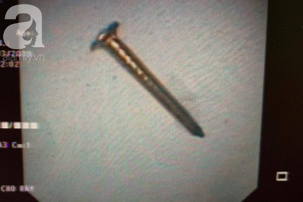 Ngậm đinh đóng ván giường rồi nuốt luôn, người đàn ông suýt chết vì đinh rớt vào phổi-4