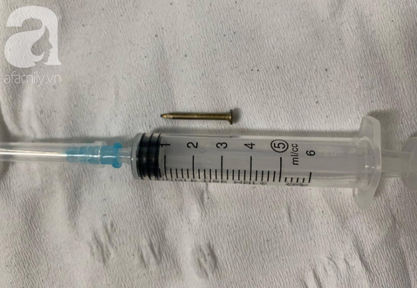 Ngậm đinh đóng ván giường rồi nuốt luôn, người đàn ông suýt chết vì đinh rớt vào phổi-5