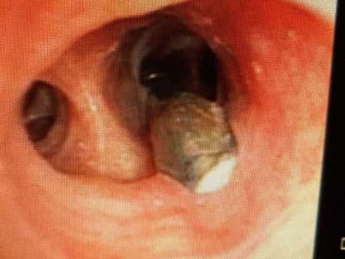 Ngậm đinh đóng ván giường rồi nuốt luôn, người đàn ông suýt chết vì đinh rớt vào phổi