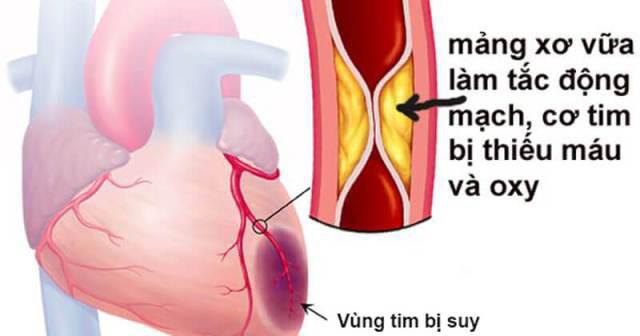 Nữ sinh lớp 7 nhồi máu cơ tim khi cắm trại, cảnh báo bệnh nguy hiểm người trẻ dễ mắc-2