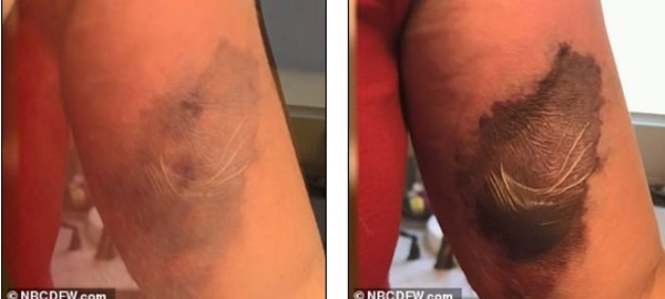 Nhiễm vi khuẩn ăn thịt người khi cất dọn đồ trang trí giáng sinh, bà mẹ 2 con suýt mất mạng-2