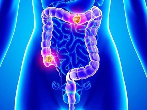 BS cảnh báo: Xem tivi 2 giờ/ngày, bệnh ung thư nguy hiểm này sẽ lớn lên nhanh chóng-2