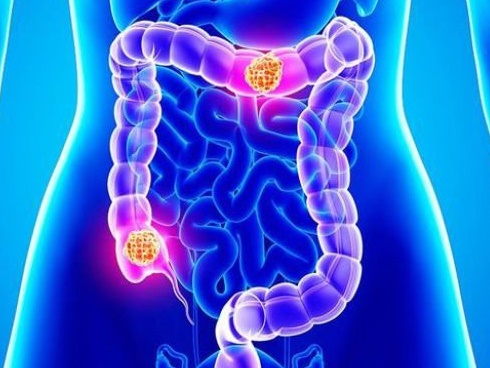 Các triệu chứng ung thư đại trực tràng rất dễ bị bỏ qua-4