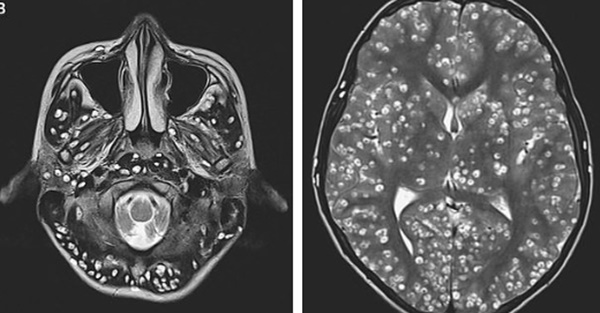 Ăn thịt lợn chưa nấu chín, nam thanh niên 18 tuổi tử vong vì nhiễm sán lợn trong não-2
