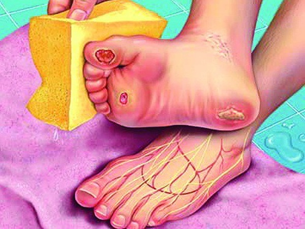 Cẩn thận với 6 dấu hiệu khác thường ở bàn chân đang ngầm cảnh báo bệnh-3