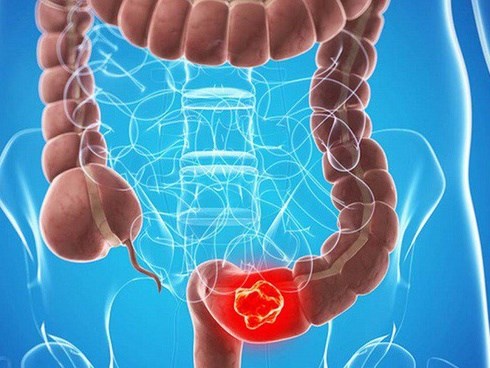 Các triệu chứng ung thư đại trực tràng rất dễ bị bỏ qua