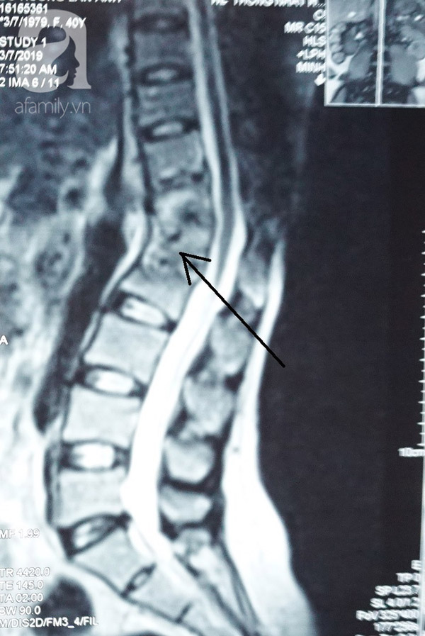 Thấy sốt về chiều và đau lưng nên đi khám ngay nếu không muốn bị bệnh khổ sở như người phụ nữ này-2
