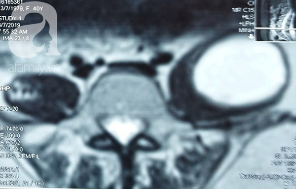 Thấy sốt về chiều và đau lưng nên đi khám ngay nếu không muốn bị bệnh khổ sở như người phụ nữ này-3