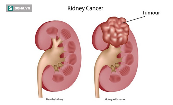 4 yếu tố chủ yếu có thể dẫn đến ung thư thận: Bất kỳ lứa tuổi nào cũng nên biết để tránh-1