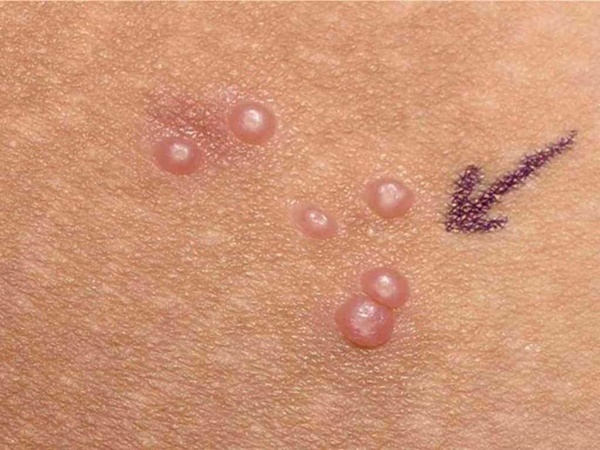 Nguồn lây không ngờ tới có thể khiến bạn mắc lậu, sùi mào gà-1