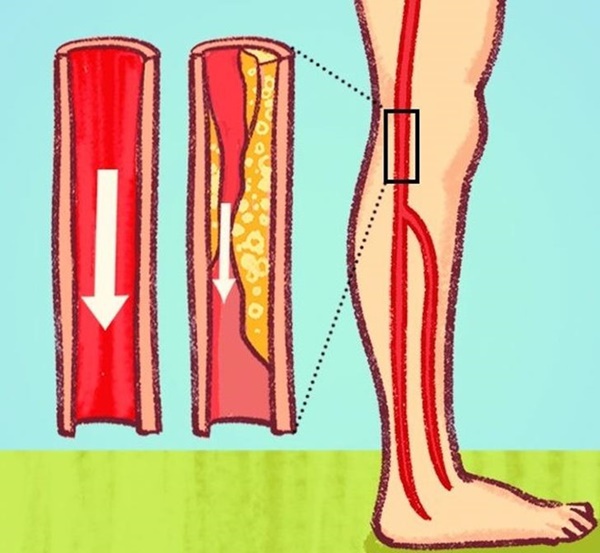 Dấu hiệu nguy hiểm cảnh báo tắc nghẽn động mạch-6