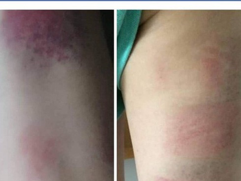 Đánh 22 học sinh tím chân, cô giáo bị đình chỉ dạy 1 tháng-2