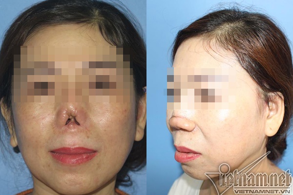 Mũi quý bà Sài Gòn cụt lủn sau nâng mũi tại thẩm mỹ viện-2