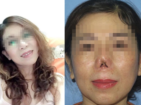 Cô gái nghĩ đến cái chết vì sửa mũi hỏng liên tục đến mức lòi sụn, biến dạng-5