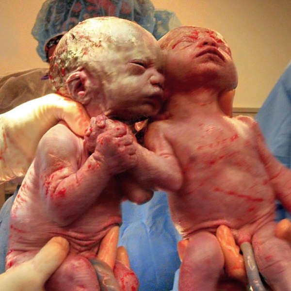 Sau 5 năm, 2 bé gái trong bức ảnh cặp song sinh nắm chặt tay nhau chào đời từng gây bão mạng xã hội giờ đã lớn khôn, có một điểm kỳ lạ khó giải thích nổi-3