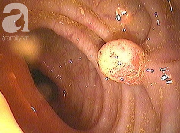 Nghệ sĩ hài Anh Vũ phát hiện ung thư khi mới 28 tuổi: Cẩn trọng với thói quen ăn uống dẫn đến ung thư đại tràng-2