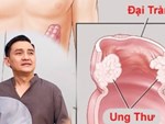 Dấu hiệu sớm cảnh báo ung thư đại tràng-2