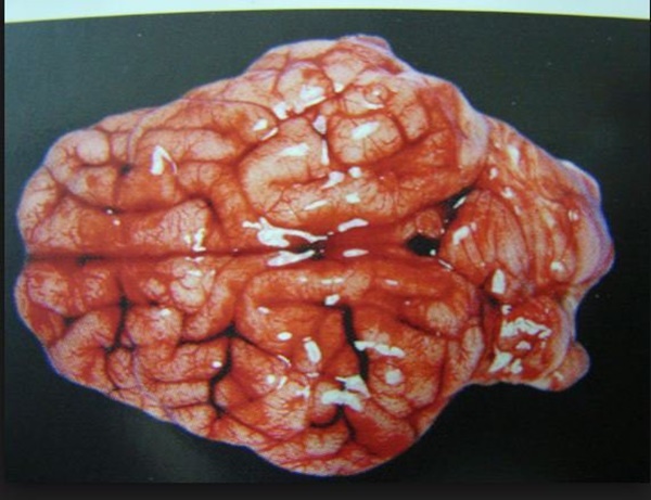 Bác sĩ cảnh báo đau đầu kiểu này là dấu hiệu của căn bệnh tử vong rất nhanh-1