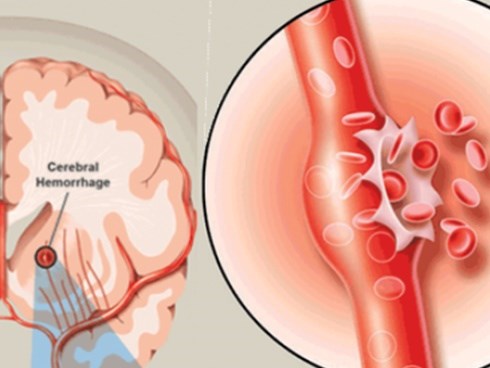 Bác sĩ cảnh báo đau đầu kiểu này là dấu hiệu của căn bệnh tử vong rất nhanh