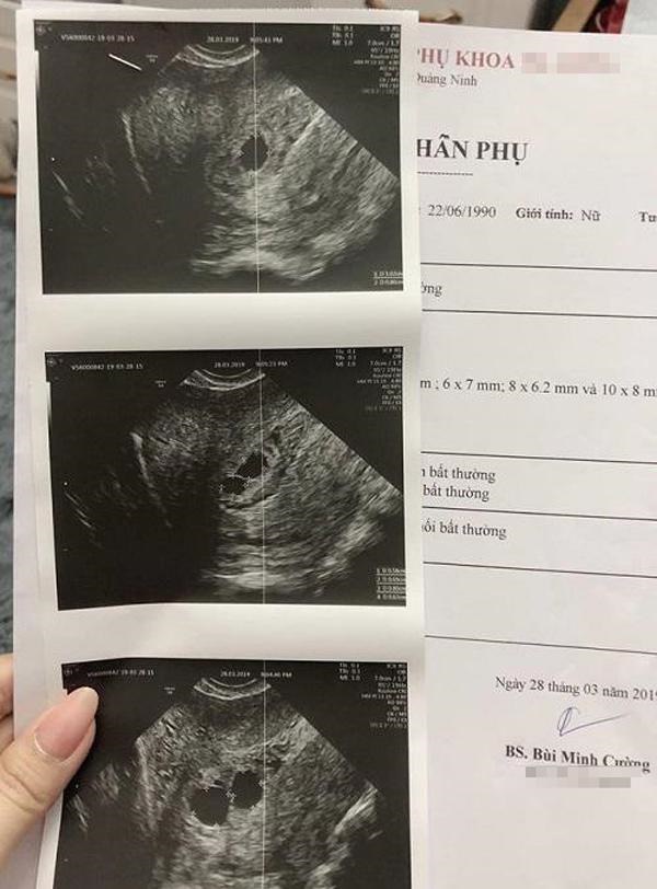 Mẹ Quảng Ninh đi siêu âm thai lần 2, bác sĩ choáng váng khi soi hình ảnh trong tử cung-3