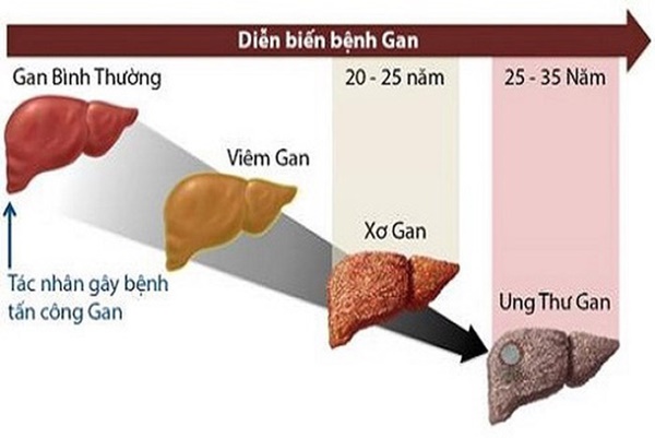 Sư tử Kim Loan - học trò của cố nghệ sĩ Trần Lập qua đời vì ung thư gan: Dấu hiệu nhận biết căn bệnh gây tử vong cao này-3