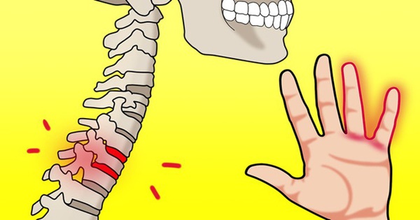 Tay bị tê có thể là do những bệnh nghiêm trọng này: Nếu không may bị thì bạn phải đi khám ngay-9