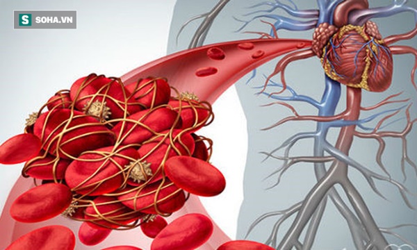 5 triệu chứng ngầm cảnh báo về bệnh huyết khối: Hậu quả nặng nề có thể bạn chưa biết-1