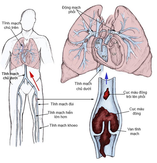5 triệu chứng ngầm cảnh báo về bệnh huyết khối: Hậu quả nặng nề có thể bạn chưa biết-3