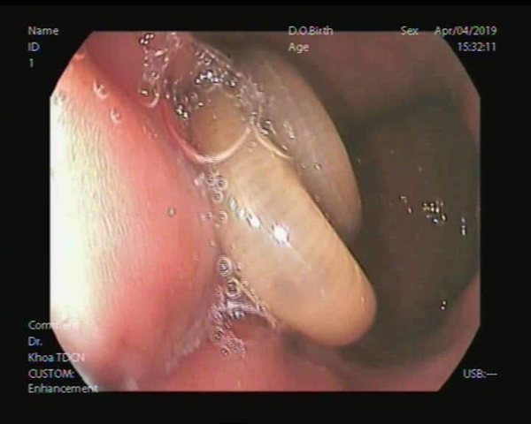 Bắt giun đũa dài gần gang tay trong dạ dày nữ bệnh nhân-2